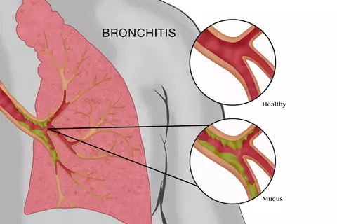 Grafik einer Bronchitis