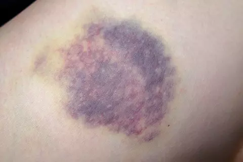 Blauer Fleck