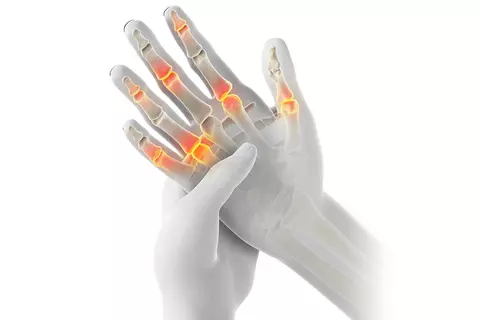 Grafik von Arthritis in den Händen