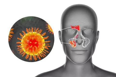 Grafik eines Menschen mit Sinusitis
