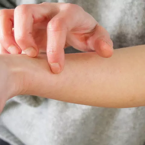 Kratzen an der Hand