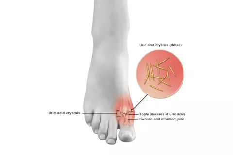 Gichtanfall: Wie lange dauert die Genesung? Gichtanfall: Wie lange dauert die Genesung?